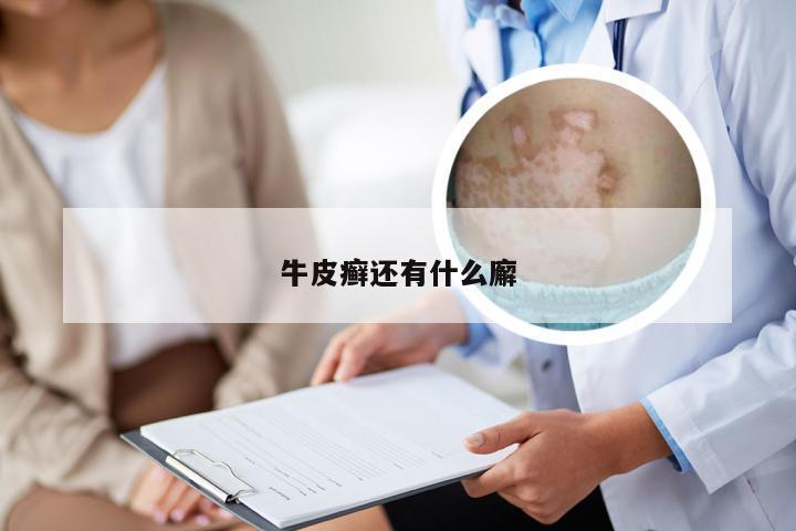 牛皮癣还有什么廨