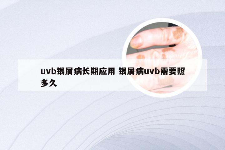 uvb银屑病长期应用 银屑病uvb需要照多久