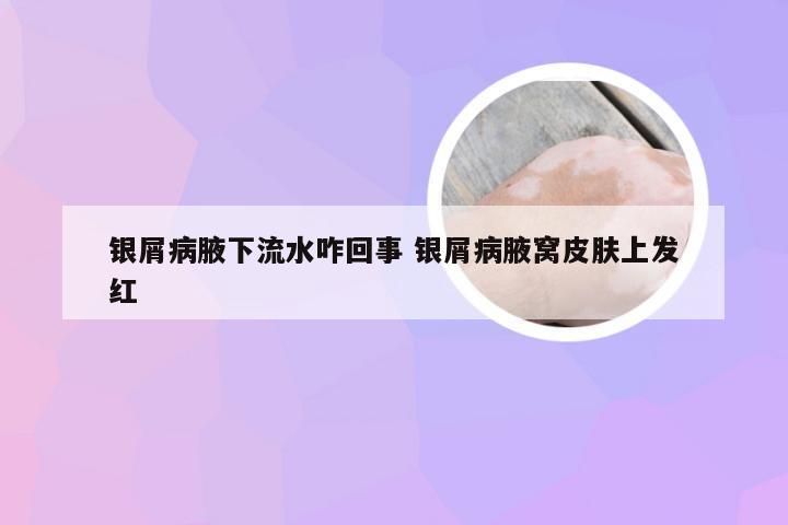 银屑病腋下流水咋回事 银屑病腋窝皮肤上发红