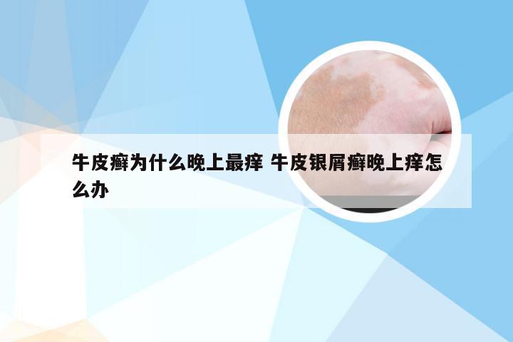 牛皮癣为什么晚上最痒 牛皮银屑癣晚上痒怎么办