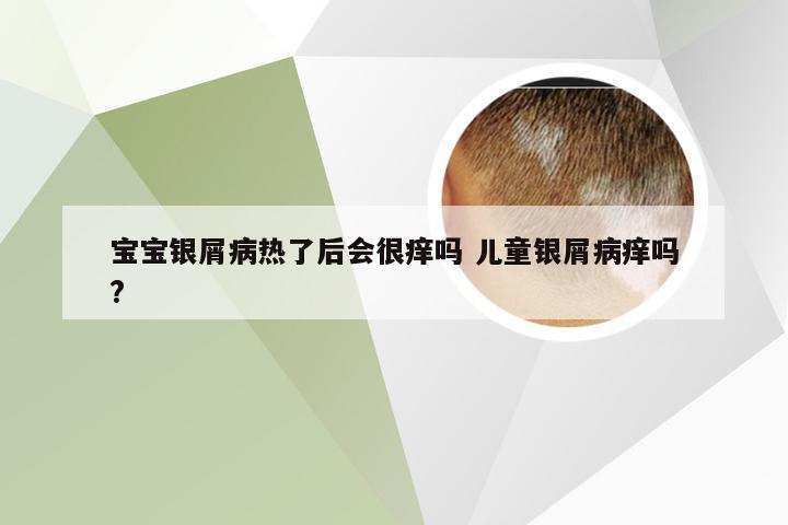 宝宝银屑病热了后会很痒吗 儿童银屑病痒吗?