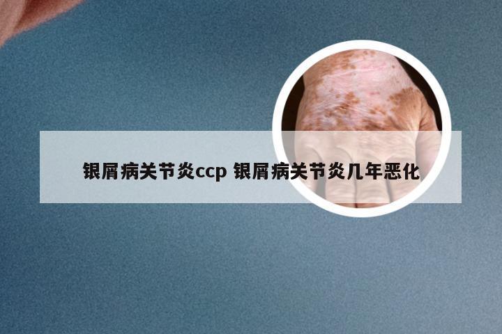 银屑病关节炎ccp 银屑病关节炎几年恶化