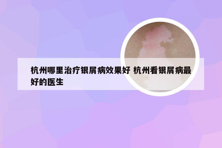 杭州哪里治疗银屑病效果好 杭州看银屑病最好的医生