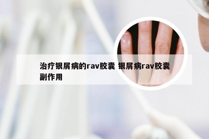 治疗银屑病的rav胶囊 银屑病rav胶囊副作用