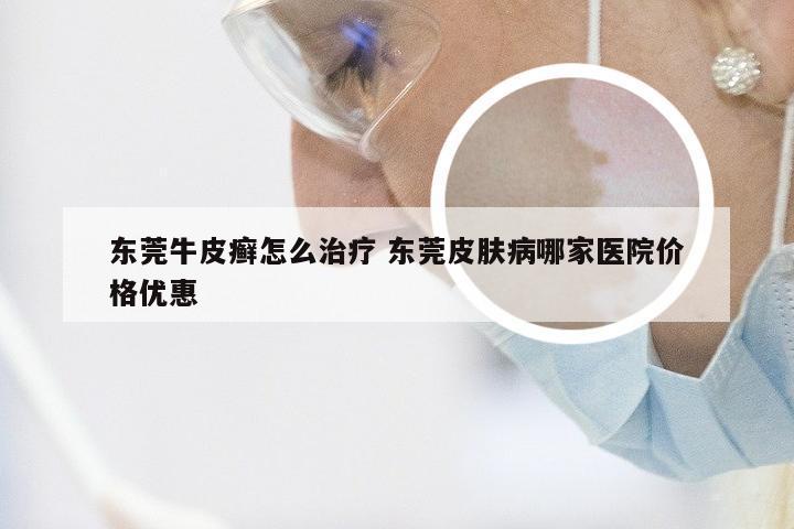 东莞牛皮癣怎么治疗 东莞皮肤病哪家医院价格优惠