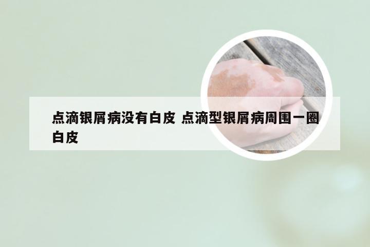 点滴银屑病没有白皮 点滴型银屑病周围一圈白皮