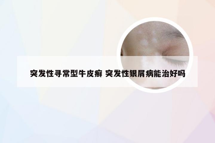 突发性寻常型牛皮癣 突发性银屑病能治好吗