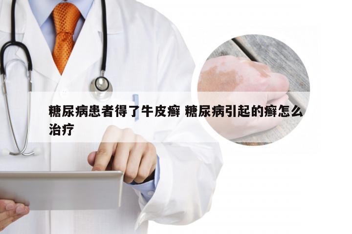 糖尿病患者得了牛皮癣 糖尿病引起的癣怎么治疗