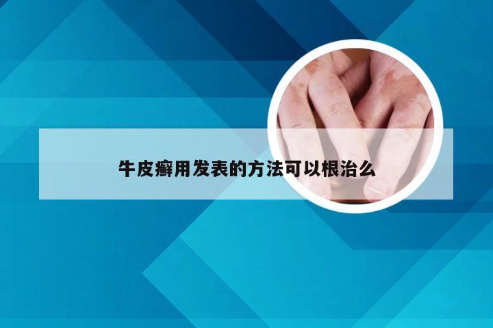 牛皮癣用发表的方法可以根治么