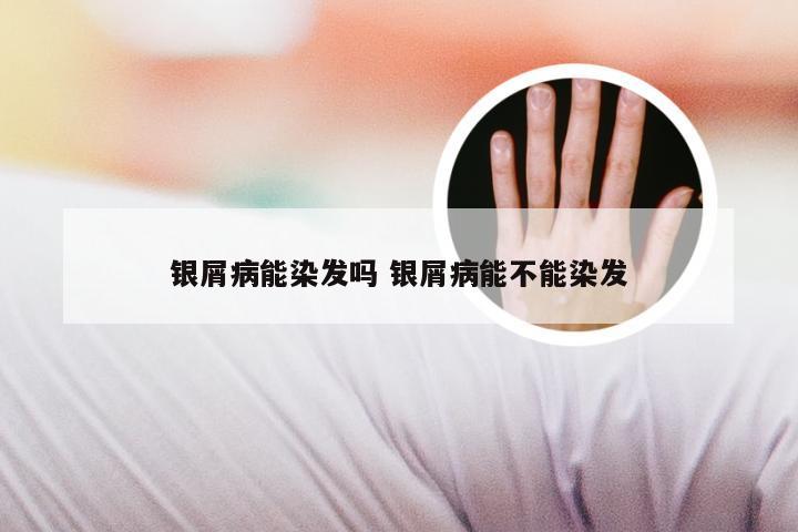 银屑病能染发吗 银屑病能不能染发