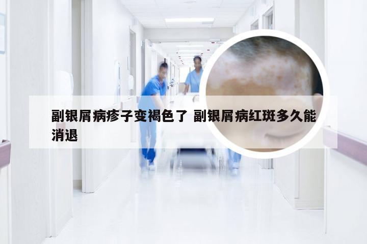 副银屑病疹子变褐色了 副银屑病红斑多久能消退