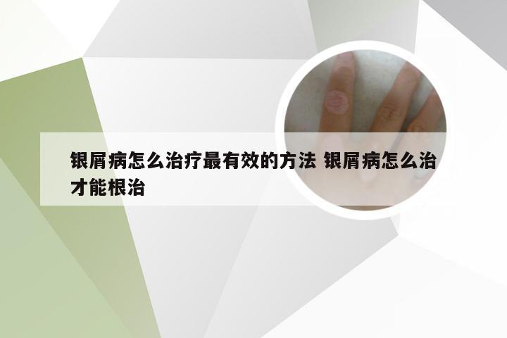 银屑病怎么治疗最有效的方法 银屑病怎么治才能根治