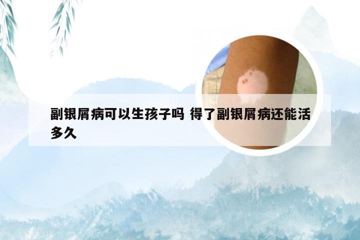 副银屑病可以生孩子吗 得了副银屑病还能活多久