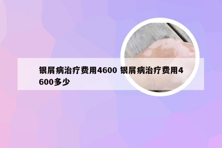 银屑病治疗费用4600 银屑病治疗费用4600多少