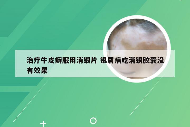 治疗牛皮癣服用消银片 银屑病吃消银胶囊没有效果