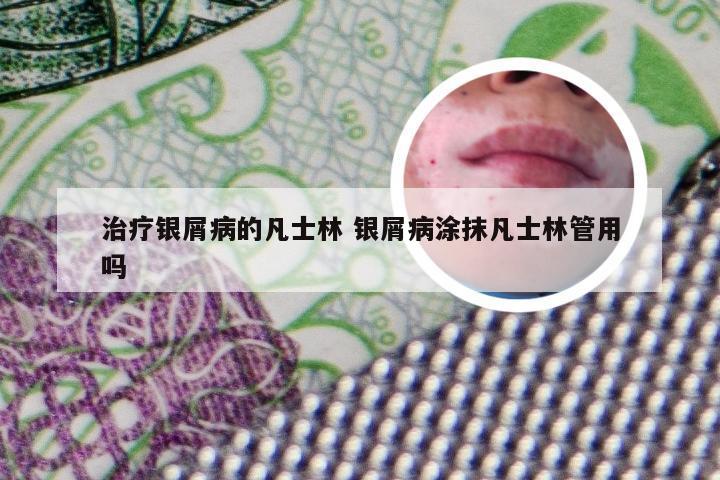 治疗银屑病的凡士林 银屑病涂抹凡士林管用吗