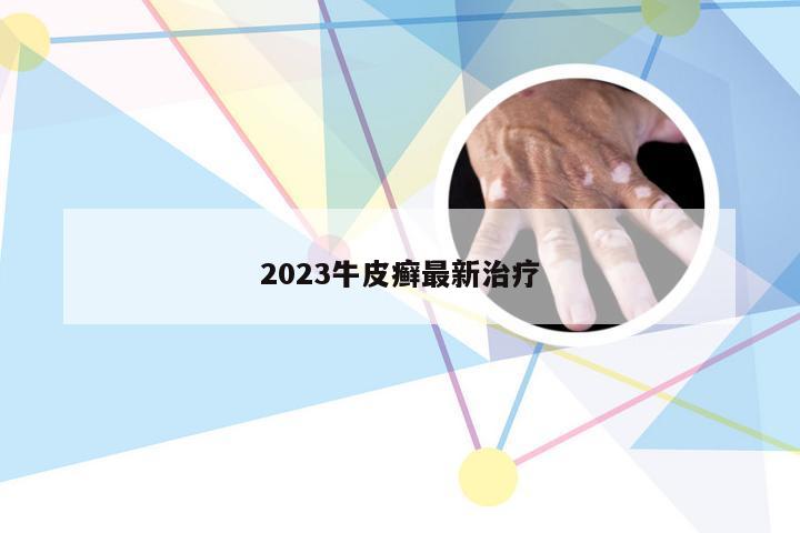 2023牛皮癣最新治疗