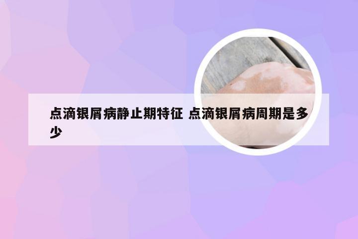 点滴银屑病静止期特征 点滴银屑病周期是多少