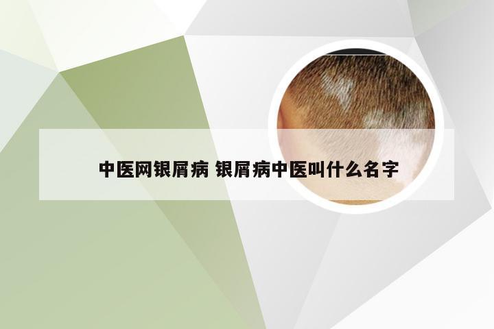 中医网银屑病 银屑病中医叫什么名字