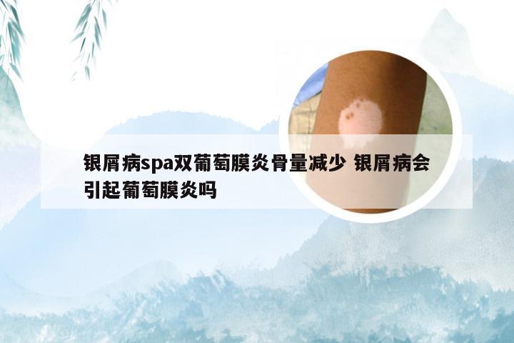 银屑病spa双葡萄膜炎骨量减少 银屑病会引起葡萄膜炎吗