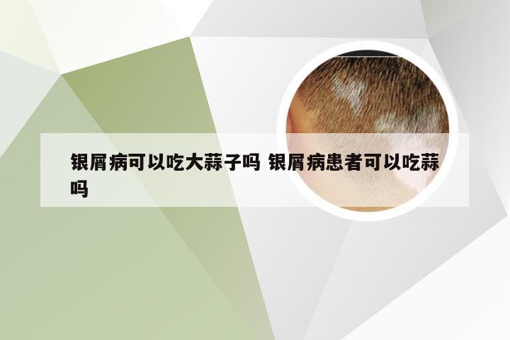 银屑病可以吃大蒜子吗 银屑病患者可以吃蒜吗