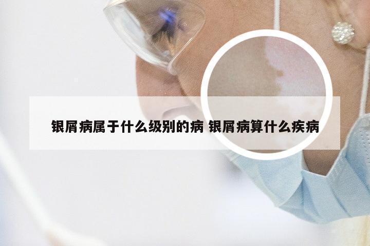 银屑病属于什么级别的病 银屑病算什么疾病