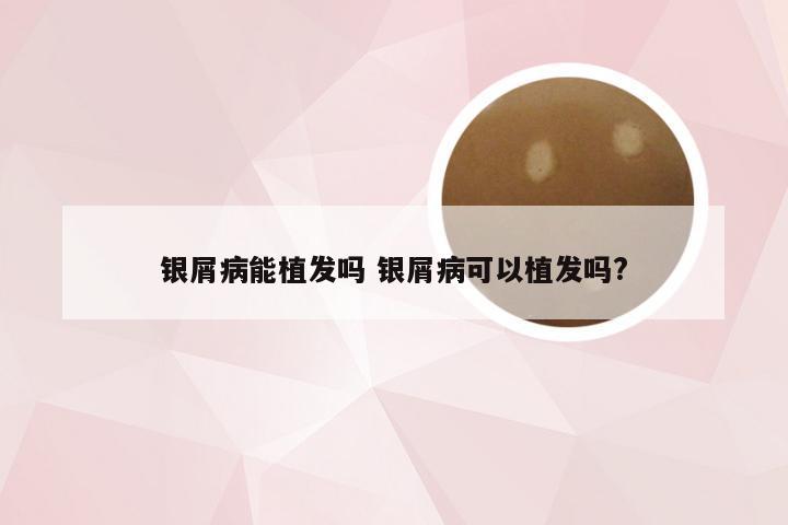 银屑病能植发吗 银屑病可以植发吗?