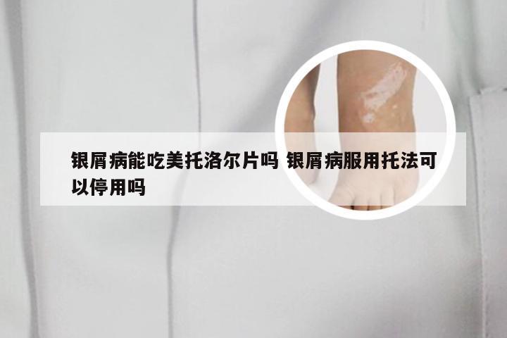 银屑病能吃美托洛尔片吗 银屑病服用托法可以停用吗