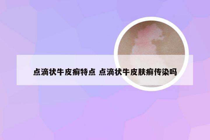 点滴状牛皮癣特点 点滴状牛皮肤癣传染吗