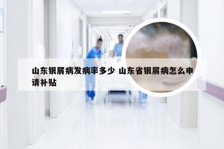 山东银屑病发病率多少 山东省银屑病怎么申请补贴