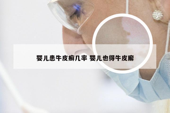 婴儿患牛皮癣几率 婴儿也得牛皮廨