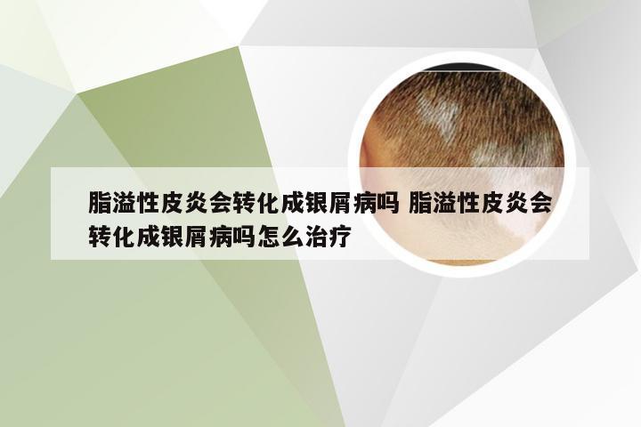 脂溢性皮炎会转化成银屑病吗 脂溢性皮炎会转化成银屑病吗怎么治疗