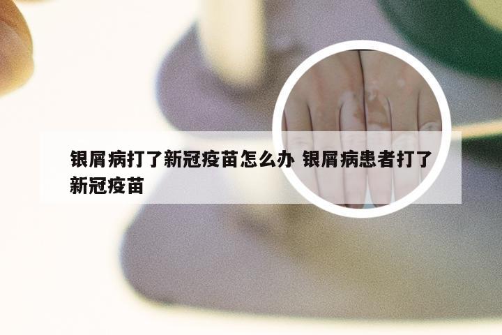 银屑病打了新冠疫苗怎么办 银屑病患者打了新冠疫苗