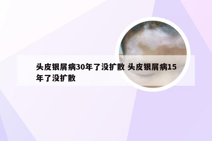 头皮银屑病30年了没扩散 头皮银屑病15年了没扩散