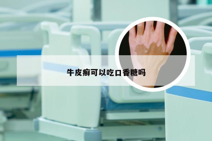 牛皮癣可以吃口香糖吗