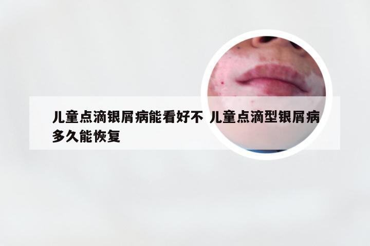 儿童点滴银屑病能看好不 儿童点滴型银屑病多久能恢复