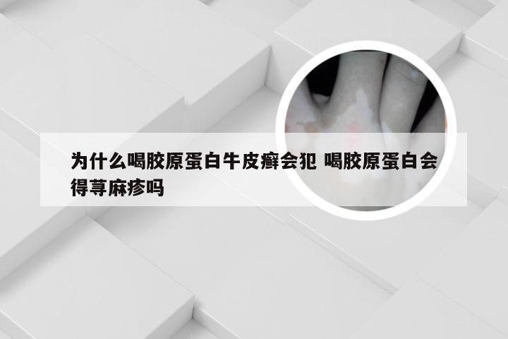 为什么喝胶原蛋白牛皮癣会犯 喝胶原蛋白会得荨麻疹吗