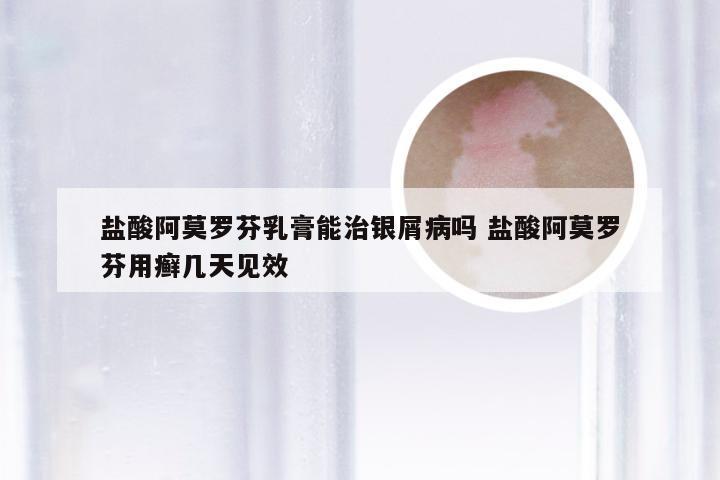 盐酸阿莫罗芬乳膏能治银屑病吗 盐酸阿莫罗芬用癣几天见效