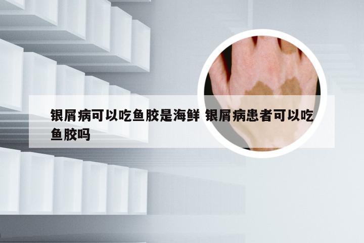 银屑病可以吃鱼胶是海鲜 银屑病患者可以吃鱼胶吗