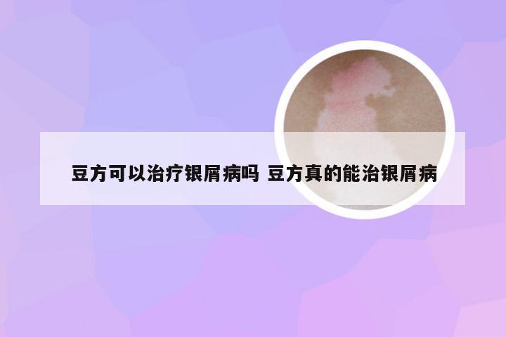 豆方可以治疗银屑病吗 豆方真的能治银屑病