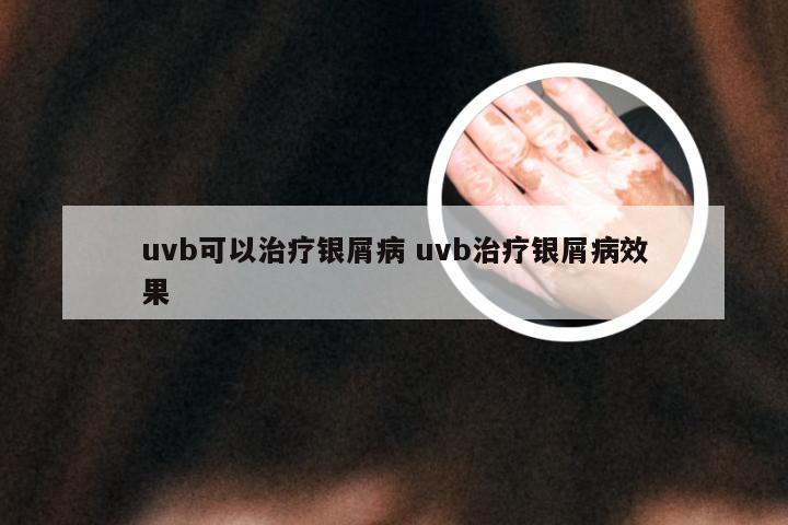 uvb可以治疗银屑病 uvb治疗银屑病效果