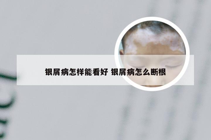 银屑病怎样能看好 银屑病怎么断根