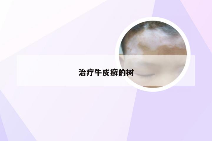 治疗牛皮癣的树