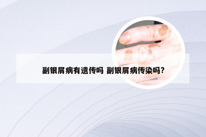 副银屑病有遗传吗 副银屑病传染吗?