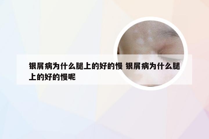 银屑病为什么腿上的好的慢 银屑病为什么腿上的好的慢呢