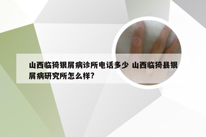 山西临猗银屑病诊所电话多少 山西临猗县银屑病研究所怎么样?