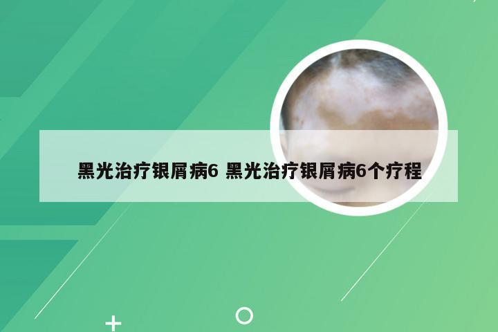 黑光治疗银屑病6 黑光治疗银屑病6个疗程