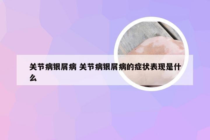 关节病银屑病 关节病银屑病的症状表现是什么