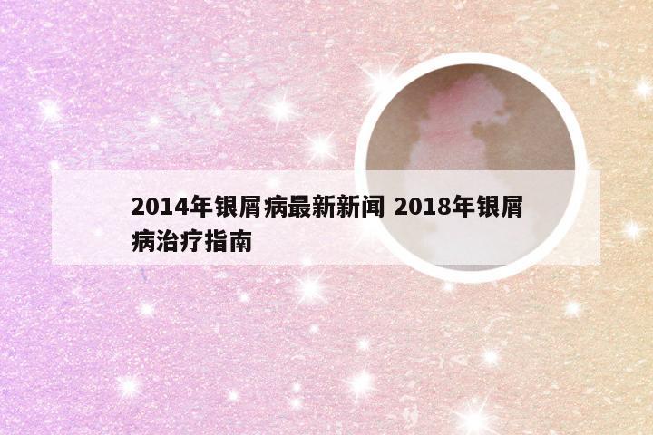 2014年银屑病最新新闻 2018年银屑病治疗指南