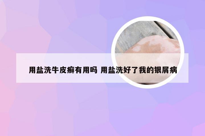 用盐洗牛皮癣有用吗 用盐洗好了我的银屑病